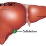 NHIF Liver Transplant cost