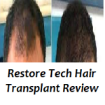 Restore Tech Hair Transplant Review