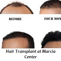 Hair Transplant at Marcia Center