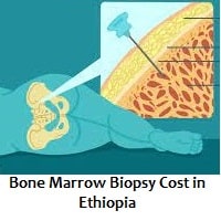 Bone Marrow Biopsy Cost in Ethiopia