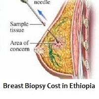 Breast Biopsy Cost in Ethiopia