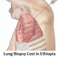 Lung Biopsy Cost in Ethiopia