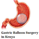 Gastric Balloon Surgery cost in Kenya