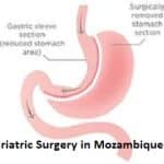Bariatric Surgeon in Mozambique