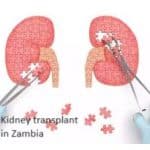 Kidney transplant in Zambia