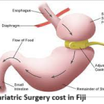 Bariatric Surgery cost in Fiji