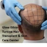 Ethio-Turkiye Hair Transplant & Skin Care Center