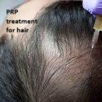 PRP treatment for hair