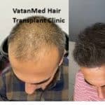 VatanMed Hair Transplant Clinic