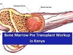 Bone Marrow Pre Transplant Workup in Kenya